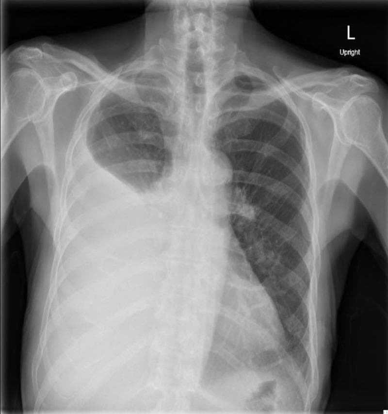 Anterior-posterior (AP) upright chest radiograph demonstrating a large, dense, homogeneous opacity occupying the lower two-thirds of the right hemithorax. The opacity exhibits a classic curvilinear superior border, or Ellis-Damoisseau line, consistent with a large pleural effusion. This finding results in complete obscuration of the right hemidiaphragm (positive silhouette sign) and the right costophrenic angle. There is a perceptible mass effect, evidenced by a slight contralateral shift of the mediastinum towards the left. In contrast, the left lung field appears clear with normal bronchovascular markings and a well-defined diaphragmatic contour. The skeletal structures and visible soft tissues are unremarkable. This diagnostic image is used to educate on the radiographic presentation of pleural fluid accumulation and its associated clinical signs, such as decreased breath sounds and dullness to percussion in the context of metastatic disease.