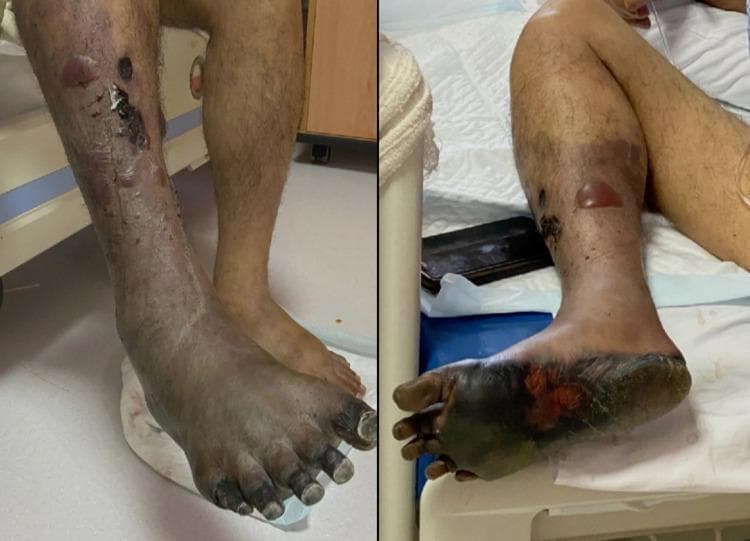 Clinical photograph of a right lower limb demonstrating concurrent dry and wet gangrene secondary to acute arterial insufficiency. The distal foot, including all phalanges, the dorsum, and the plantar surface, exhibits characteristic dry gangrene, visualized as mummified, shriveled, and dark black tissue with distinct demarcation. Proximal to the ankle, the lower leg shows signs of wet gangrene, characterized by significant edema, skin maceration, and the presence of multiple large, fluid-filled bullae and blisters. Notable tissue breakdown and serosanguinous discharge are visible on the pretibial and lateral surfaces of the leg. A clear line of demarcation is emerging below the knee, separating the necrotic, infected tissue from the viable proximal limb. This visual illustrates the progression of critical limb-threatening ischemia and the transformation from dry to infected wet gangrene, a surgical emergency requiring urgent intervention such as amputation to prevent systemic sepsis.