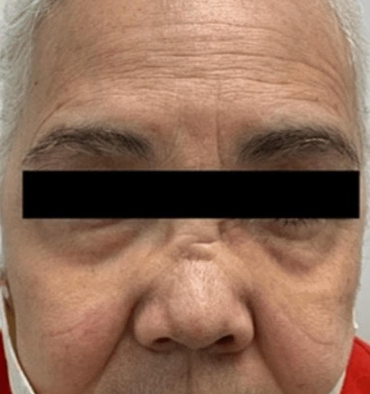 This clinical photograph shows a close-up frontal view of a patient's face, highlighting a classic saddle-nose deformity. The most prominent feature is a significant depression and collapse of the nasal bridge, creating a concave contour between the forehead and the nasal tip. The cartilaginous portion of the nose appears shortened, leading to a subtle cephalad (upturned) rotation of the nasal tip. These structural changes are characteristic manifestations of Granulomatosis with Polyangiitis (formerly Wegener's granulomatosis), where chronic inflammation and vasculitis lead to the destruction of the nasal septal cartilage. Additional visible features include moderate periorbital puffiness and age-related changes such as prominent forehead rhytids (wrinkles), nasolabial folds, and skin mottling. The image serves as a clinical example of the destructive impact of autoimmune small-vessel vasculitis on facial skeletal and cartilaginous structures.