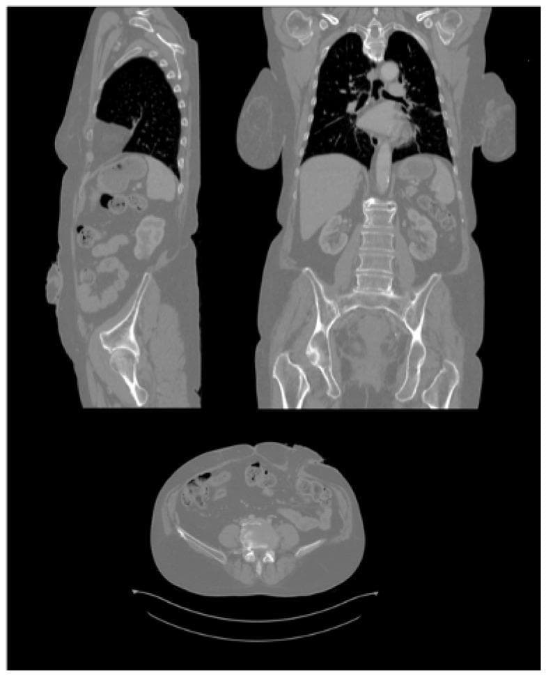 This diagnostic image displays a multiplanar reconstruction of a human abdominal Computed Tomography (CT) scan, presented in sagittal (top left), coronal (top right), and axial (bottom) planes. The sagittal view provides a side perspective of the torso, showing the thoracic cavity with air-filled (hypodense) lungs, the diaphragmatic boundary, abdominal viscera including the liver and intestinal loops, and the spinal column. The coronal view offers a frontal orientation, highlighting the bilateral symmetry of the lungs, the heart in the mediastinum, the liver, kidneys, and the pelvic girdle. The axial view displays a transverse cross-section through the lower abdomen, prominently showing the vertebral body, surrounding musculature, subcutaneous adipose tissue, and intestinal segments. Of particular clinical note is the presence of an ostomy site on the anterior abdominal wall, visible as a protrusion in both the sagittal and axial planes. These images serve as primary anatomical data for surgical planning, specifically for designing personalized ostomy patches adapted to the patient's unique abdominal contours.