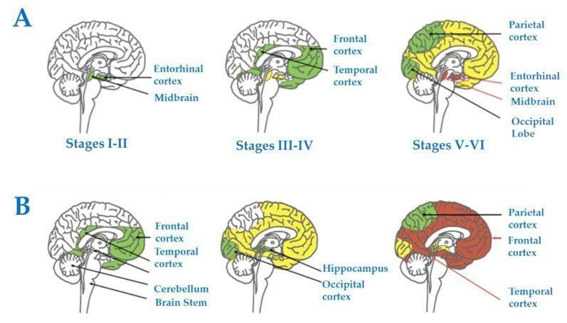 Educational medical diagram illustrating the neuropathological progression of Alzheimer's disease across two distinct pathways: (A) Tau pathology (neurofibrillary tangles, NFTs) according to Braak staging, and (B) ̢-amyloid pathology (senile plaques, SPs). Panel A uses sagittal brain sections to show Tau spreading from the entorhinal cortex and midbrain (Stages I-II) to the temporal and frontal cortices (Stages III-IV), finally involving the parietal cortex and occipital lobe (Stages V-VI). Panel B demonstrates ̢-amyloid deposition starting in the frontal and temporal cortices, progressing to the hippocampus and occipital cortex, and eventually involving the cerebellum and brainstem. The visual uses color coding (green, yellow, red) to signify the temporal and spatial expansion of pathology. This content is designed for medical education regarding the spatiotemporal evolution of AD biomarkers and the anatomical basis for Braak staging, highlighting the specific vulnerability of the entorhinal cortex as an early site of disease manifestation.