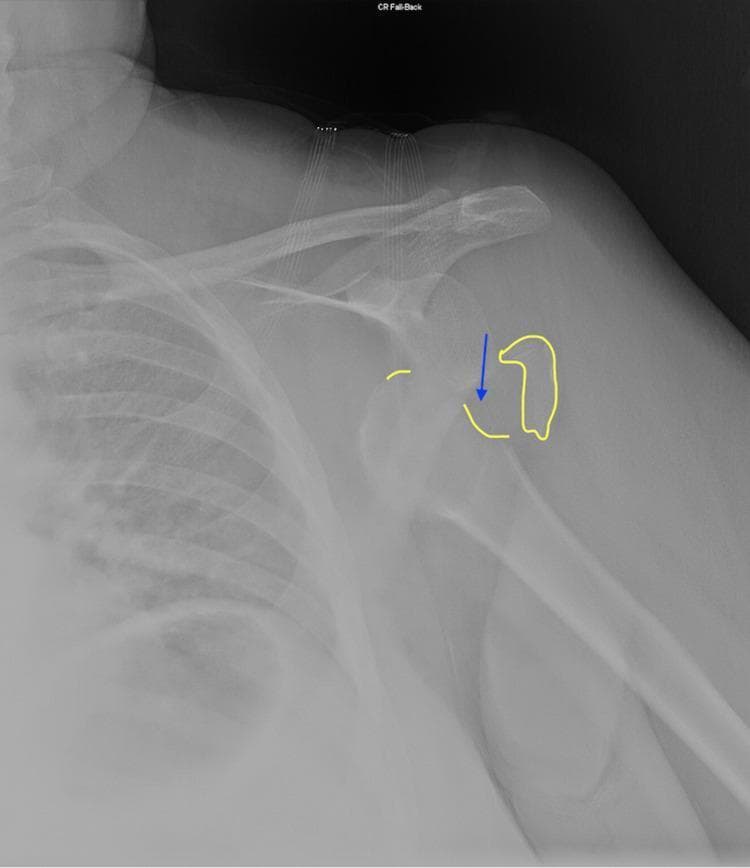 This diagnostic radiograph (X-ray) of the left shoulder in an anteroposterior (AP) view demonstrates an anterior-inferior glenohumeral dislocation. The humeral head is displaced from the glenoid fossa and is positioned medially and inferiorly. A key educational feature is the Hill-Sachs lesion, a compression fracture of the posterolateral humeral head, which is highlighted with a blue arrow and a yellow outline indicating the cortical depression. This lesion typically occurs when the humeral head impacts the anterior glenoid rim during dislocation. Additionally, a small radio-opaque fragment is outlined in yellow near the medial aspect of the joint, suggestive of a possible bony Bankart lesion or a loose fracture fragment. The image serves as a clinical example of trauma-induced shoulder instability and associated secondary fractures, which are critical for surgical planning and risk assessment for recurrent dislocations in orthopedics.