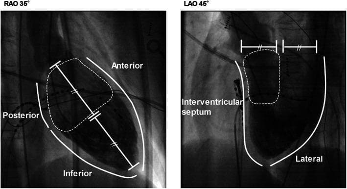 Two grayscale fluoroscopic images illustrate cardiac anatomy and classification criteria for proximal versus non-proximal ventricular arrhythmias. The left panel shows a Right Anterior Oblique (RAO 35°) projection, with labels for the anterior, posterior, and inferior aspects of the heart. A solid white line outlines the cardiac silhouette, while a dashed region defines the proximal half of the heart, where structures like the His bundle and proximal fascicles are located. A bisecting line with tick marks indicates the division between proximal and distal sections. The right panel shows a Left Anterior Oblique (LAO 45°) projection, highlighting the interventricular septum and lateral wall. A similar dashed area delineates the targeted septal and proximal anterior wall regions. These images serve as a fluoroscopic guide for identifying successful ablation sites in patients with focal Purkinje ventricular arrhythmias, emphasizing anatomical landmarks used to differentiate arrhythmia origins based on septal and proximal proximity.