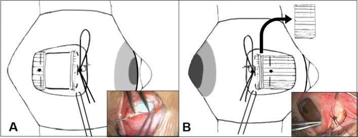 Educational diagram and intraoperative clinical photographs illustrating adjustable suture techniques in strabismus surgery. Figure A depicts a recession of the lateral rectus muscle using a hang-back technique. The muscle is disinserted and secured to the scleral insertion point with a single-loop bow-tie suture, allowing for postoperative adjustment. A 4-0 Vicryl bolster suture is placed below the bow-tie to facilitate easy untying, and a 6-0 Vicryl traction suture is anchored near the insertion site for exposure. Figure B shows a resection of the medial rectus muscle. The resected muscle is suspended approximately 2 mm posterior to the original insertion site, secured again with a single-loop bow-tie and bolster suture. This suspension creates necessary space for potential muscle advancement during the adjustment phase. The medical illustrations are paired with small clinical photographs of the respective surgical fields, highlighting the 'bow-tie' suture configuration used for fine-tuning ocular alignment postoperatively under topical anesthesia.
