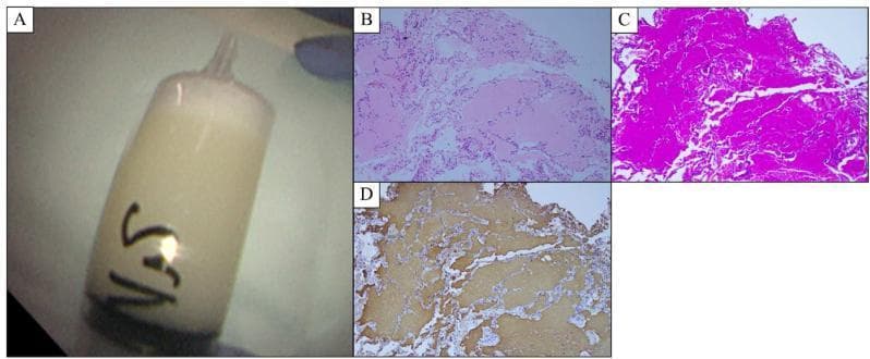 This composite image illustrates the diagnostic findings of pulmonary alveolar proteinosis (PAP). Panel A is a clinical photograph of bronchoalveolar lavage fluid (BALF) in a syringe, demonstrating a pathognomonic opaque, milky-white appearance due to surfactant accumulation. Panels B, C, and D are photomicrographs (100x magnification) of a transbronchial lung biopsy. Panel B (Hematoxylin and Eosin stain) shows alveolar spaces filled with an acellular, granular, and eosinophilic amorphous material, while the underlying alveolar architecture remains preserved. Panel C (Periodic Acid-Schiff stain) demonstrates that this intra-alveolar material is strongly PAS-positive, appearing deep magenta, which indicates a high carbohydrate/glycoprotein content. Panel D (Immunohistochemistry) shows positive brown staining for surfactant protein A within the alveolar exudate. Collectively, these images illustrate the characteristic macroscopic and histologic features of PAP, where impaired surfactant clearance leads to its accumulation within the distal air spaces, resulting in respiratory compromise.