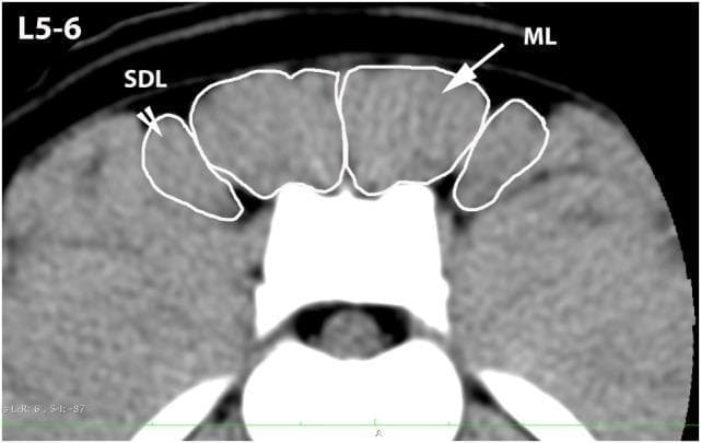 This diagnostic image is a transverse computerized tomography (CT) scan at the level of the L5-L6 vertebrae, focusing on the paraspinal musculature. The image demonstrates the cross-sectional anatomy of the lumbar spine and its associated soft tissue structures. Key anatomical regions are highlighted with white outlines to define the margins for clinical or research analysis. The Multifidus Lumborum (ML) is identified as the prominent muscle group located immediately lateral to the dorsal spinous processes. Positioned further lateral to the ML is the Sacrocaudalis Dorsalis Lateralis (SDL) muscle. Both muscle groups exhibit a relatively uniform soft-tissue density. The image illustrates the spatial relationship and precise borders of these muscles relative to the central vertebral body and dorsal bony landmarks. This type of imaging is typically used in musculoskeletal assessments to evaluate muscle cross-sectional area, symmetry, and potential atrophy or pathology in the lumbosacral region.
