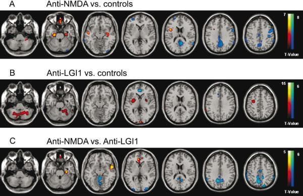 This diagnostic image series presents axial 18F-FDG PET/MRI brain scans demonstrating metabolic patterns in autoimmune encephalitis. The images utilize statistical parametric mapping (SPM) with color-coding: red-to-yellow indicates hypermetabolism and blue-to-green indicates hypometabolism. Row A (Anti-NMDA receptor encephalitis vs. controls) reveals focal temporomesial (hippocampal/parahippocampal) hypermetabolism alongside widespread hypometabolism in the precuneus, parietal, and posterior cingulate cortex. Row B (Anti-LGI1 encephalitis vs. controls) shows hypermetabolism in the basal ganglia, cerebellum, and precentral regions, with hypometabolism limited to the frontomesial/anterior cingulate cortex. Row C (Direct comparison: Anti-NMDA vs. Anti-LGI1) highlights that anti-NMDA patients have relatively higher metabolism in frontotemporal regions but significantly lower metabolism in the precuneus and parietal/occipital cortices compared to anti-LGI1 patients. This comparison illustrates the distinct metabolic signatures used to differentiate between specific autoimmune encephalitides in a clinical neurology and nuclear medicine context.