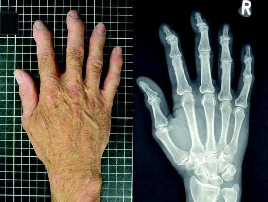 This composite image provides a side-by-side comparison of a clinical photograph and a corresponding posterior-anterior radiograph of a human right hand, demonstrating features of hand osteoarthritis (OA). The clinical photograph on the left shows an aged hand with prominent skin wrinkling, solar lentigines, and dorsal venous prominence. Notable morphological changes include bony enlargement and swelling at the distal interphalangeal (DIP) and proximal interphalangeal (PIP) joints, consistent with Heberden’s and Bouchard’s nodes. Slight radial or ulnar deviation of the digits is visible. The corresponding X-ray on the right confirms degenerative joint disease, characterized by significant joint space narrowing, subchondral sclerosis, and marginal osteophyte formation, most prominently at the DIP, PIP, and first carpometacarpal (CMC) joints. The image illustrates the construct validity between clinical photographic grading and radiographic Kellgren-Lawrence (K/L) scoring for assessing disease severity in rheumatology and geriatric medicine.