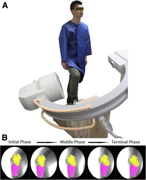 This composite image demonstrates a biomechanical research setup for in vivo knee kinematics. Panel A is a clinical photograph showing a subject wearing a lead apron, positioned on a custom staircase integrated with a single-plane fluoroscopic C-arm imaging system. This configuration is used to capture real-time radiographic data of the knee joint during weight-bearing activities like stair ascent. Panel B displays a series of fluoroscopic stills with virtual overlays (3D-to-2D registration) illustrating patellofemoral kinematics across three stages: Initial Phase, Middle Phase, and Terminal Phase. In these diagnostic frames, the patella is highlighted in yellow and the tibia in magenta. The sequence visualizes the relative 6-degree-of-freedom (6DOF) motion, showing the patella's inferior and posterior translation relative to the tibia as the knee transitions through flexion and extension. The educational focus is on the dynamic tracking of joint surfaces post-ACL reconstruction or in intact knees to evaluate functional stability and movement patterns. Medical specialty: Orthopedics and Biomechanics.