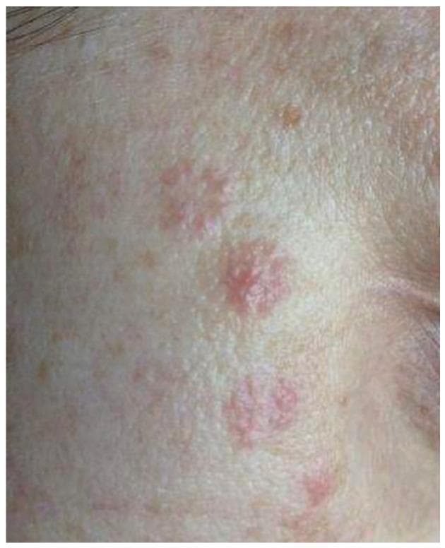 This clinical photograph displays skin lesions on the right cheek of a 38-year-old female patient, illustrating the clinical appearance of cutaneous sarcoidosis during treatment. The visual focus is on a vertical, linear distribution of erythematous, circular to oval-shaped plaques. These lesions appear as discrete, reddish-pink spots with a slightly raised or infiltrated texture. The surrounding skin exhibits a fair tone with mild solar lentigines (freckles) and a relatively smooth texture. Compared to the acute phase of the disease, these lesions show reduced infiltration and erythema, signifying a positive therapeutic response to systemic corticosteroids (prednisone). This image is an educational example of how cutaneous sarcoidosis can present as localized, discoid-like plaques on the face and demonstrates the visible healing process and flattening of granulomatous skin involvement under pharmacological management.
