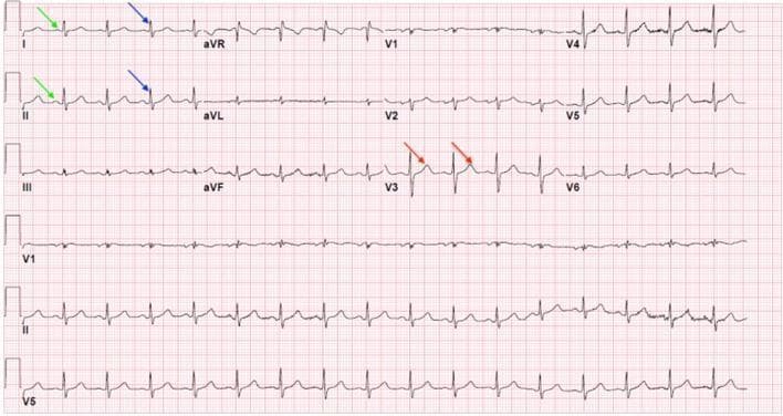 This diagnostic image shows a standard 12-lead electrocardiogram (ECG) recorded on a pink grid background. The layout consists of several horizontal strips displaying cardiac electrical activity from different leads (I, II, III, aVR, aVL, aVF, and V1–V6). Each strip exhibits the characteristic repeating PQRST wave cycle. Green arrows identify the P waves, representing atrial depolarization. Blue arrows indicate the QRS complexes, which represent ventricular depolarization and exhibit the highest amplitude in the cycle. Red arrows point to the T waves in lead V3, signifying ventricular repolarization. The morphological features vary across leads: P waves appear as small positive deflections, QRS complexes vary in polarity and height based on the lead orientation, and T waves are generally broad and rounded. At the bottom, a continuous rhythm strip (Lead II) is provided for long-term rhythm assessment. This visual is used to teach waveform identification, heart rate calculation, and the diagnosis of cardiac conditions like arrhythmias or myocardial injury.