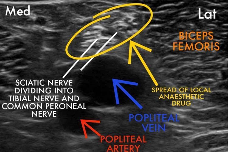 This diagnostic ultrasound image in the transverse plane demonstrates a popliteal sciatic nerve block procedure. The visual focuses on the bifurcation of the sciatic nerve into the tibial nerve and common peroneal nerve, which appear as clustered, hyperechoic (bright) circular structures within a yellow oval highlight. A prominent hypoechoic (dark) 'doughnut-shaped' area immediately surrounding the nerve represents the spread of local anesthetic within the paraneural sheath (Vloka’s sheath). Anatomical landmarks are labeled for orientation: the biceps femoris muscle is visible laterally (Lat), while the popliteal vein (blue arrow) and popliteal artery (red arrow) are situated deep (inferior) to the nerve complex as anechoic circular structures. The image illustrates the ideal circumferential distribution of anesthetic for an effective regional block. Medical specialty: Anesthesiology/Regional Anesthesia. Target level: Intermediate to Advanced (Resident/Fellow training).