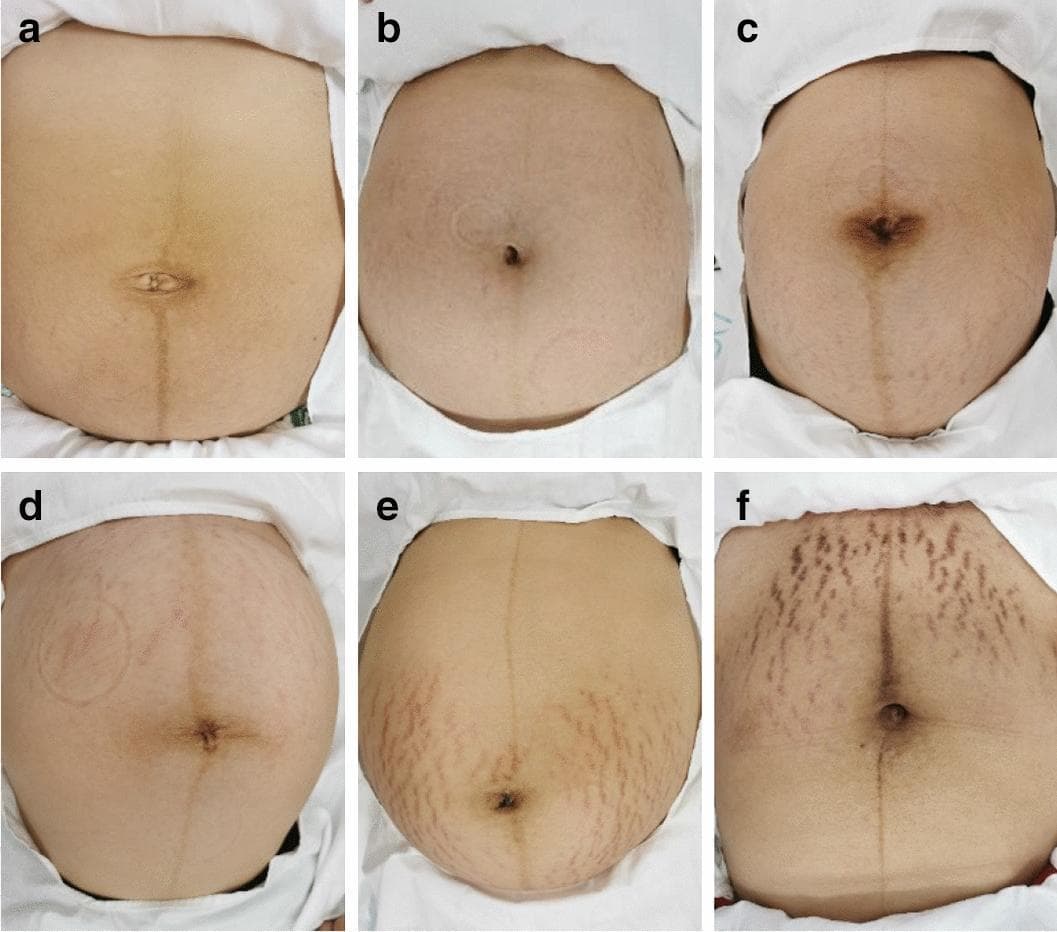 This set of six clinical photographs (a-f) displays the dermatological presentation and classification of striae gravidarum (pregnancy stretch marks) on the human abdomen. The images demonstrate a progression of severity and are organized into three clinical categories. Panels (a) and (b) represent 'mild' cases, characterized by a near-complete absence or sparse distribution of faint, thin striae that closely match the surrounding skin tone. Panels (c) and (d) represent 'moderate' cases, showing an increased density and wider distribution of visible marks across the periumbilical and lower abdominal regions. Panels (e) and (f) depict 'severe' manifestations, where the striae appear markedly more pronounced, wider, and darker (erythematous or violaceous) in color. In these severe cases, the lesions exhibit a high-density distribution pattern, extending across a larger surface area of the abdomen. A distinct linea nigra is also visible vertically across the midline in several images. This visual series is used in obstetrics and dermatology to illustrate the morphological diversity and clinical grading of striae distensae during or after pregnancy.
