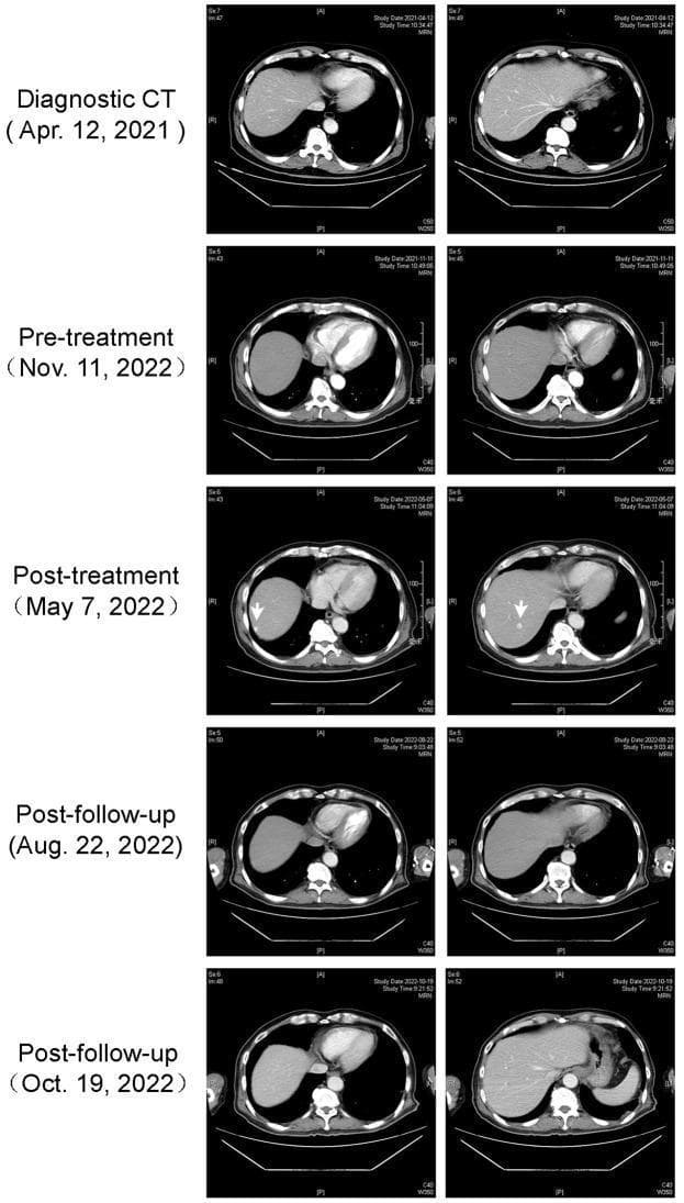 This Comparison Chart displays a series of axial contrast-enhanced CT scans of the upper abdomen over a longitudinal timeline, illustrating the progression and regression of hepatic lesions. The panels are organized into five temporal stages: 'Diagnostic CT' (Apr 2021), 'Pre-treatment' (Nov 2022), 'Post-treatment' (May 2022), and two 'Post-follow-up' sessions (Aug 2022 and Oct 2022). The 'Post-treatment' scans demonstrate two distinct, well-circumscribed, low-density (hypodense) lesions in the right liver segment S6 (indicated by white arrows), consistent with hepatic cavernous hemangiomas. Subsequent 'Post-follow-up' imaging shows a progressive reduction in the size and density of these lesions, with the final Oct 2022 scans indicating significant regression and near-disappearance of the previously visible nodules. This radiological series highlights the dynamic changes in liver pathology during and after clinical intervention, focusing on lesion morphology, margin definition, and size within the hepatic parenchyma.