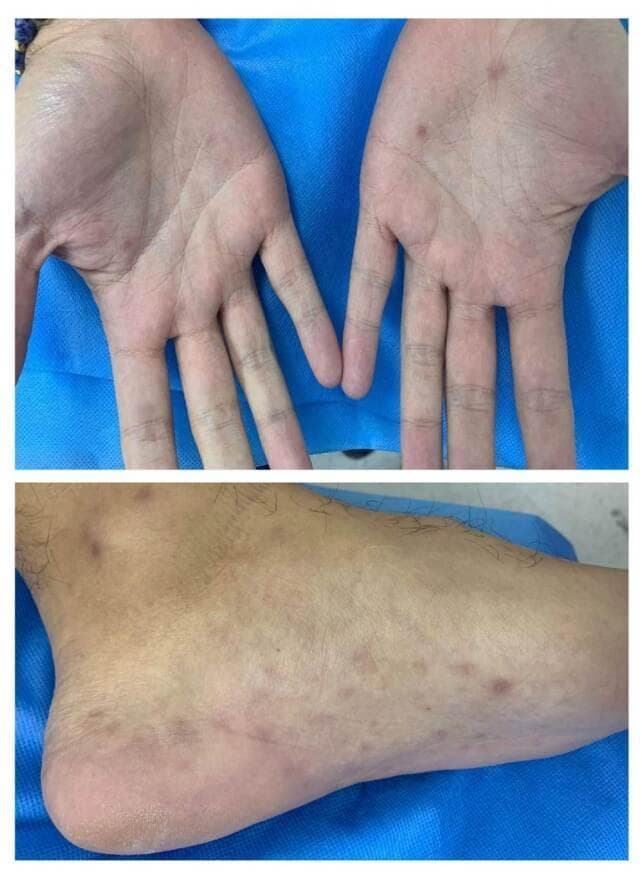 Clinical photograph showing a maculopapular rash involving the palms and soles, a hallmark presentation of secondary syphilis. The upper panel displays the bilateral palms with scattered, small (approx. 2-5 mm), well-demarcated reddish-brown macules and papules, primarily concentrated on the thenar and hypothenar eminences. The lower panel shows the plantar and lateral surfaces of a foot, featuring numerous similar hyperpigmented, erythematous lesions with a fairly even distribution across the sole and extending toward the heel and malleolar region. This classic palmoplantar distribution is a key diagnostic indicator for Treponema pallidum infection, often referred to as 'syphilitic roseola' or copper-colored spots. These lesions are typically non-pruritic but occur during the disseminated stage of the disease, often accompanied by systemic symptoms such as lymphadenopathy or jaundice, as suggested by the patient's associated laboratory findings of transaminitis and reactive RPR/FTA-ABS tests.
