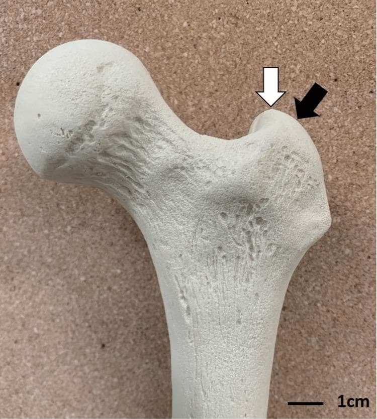 Anatomical Diagram: A high-resolution clinical photograph of a proximal human femur model, used to illustrate entry points for cephalomedullary (CM) nailing in orthopedic surgery. The image depicts the femoral head, femoral neck, and the greater trochanter. Two specific anatomical landmarks on the greater trochanter are identified with arrows: a white arrow points to the greater trochanteric tip (the most superior aspect), and a black arrow points to the 'bald spot' (a flattened or slightly depressed area on the posterior-lateral aspect of the trochanter). The bone surface exhibits natural-looking pits, ridges, and textures characteristic of cortical bone morphology. This visual is designed to assist orthopedic surgeons and residents in understanding optimal starting points for intramedullary nail insertion during the treatment of intertrochanteric fractures, highlighting the subtle differences in entry site location and their potential clinical implications.