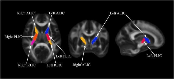 This diagnostic neuroimaging figure displays three planes of a brain MRI—axial (left), coronal (middle), and sagittal (right)—highlighting the sub-regions of the internal capsule using color-coded Regions of Interest (ROIs). The image serves as an anatomical guide for white matter localization. In the axial view, the internal capsule is segmented into the Anterior Limb (ALIC), Posterior Limb (PLIC), and Retrolenticular Limb (RLIC). On the right hemisphere, these are color-coded yellow/orange, red/orange, and magenta, respectively. On the left hemisphere, the ALIC is colored blue and the PLIC is colored red. The coronal and sagittal views further demonstrate the 3D spatial orientation: the ALIC is situated anteriorly and superiorly relative to the PLIC. These ROIs are mapped onto a grayscale structural template, likely for Fractional Anisotropy (FA) or Mean Diffusivity (MD) analysis in psychiatric or neurological research. Key landmarks visible include the ventricles and the thalamic/striatal boundaries surrounding the V-shaped internal capsule structure.