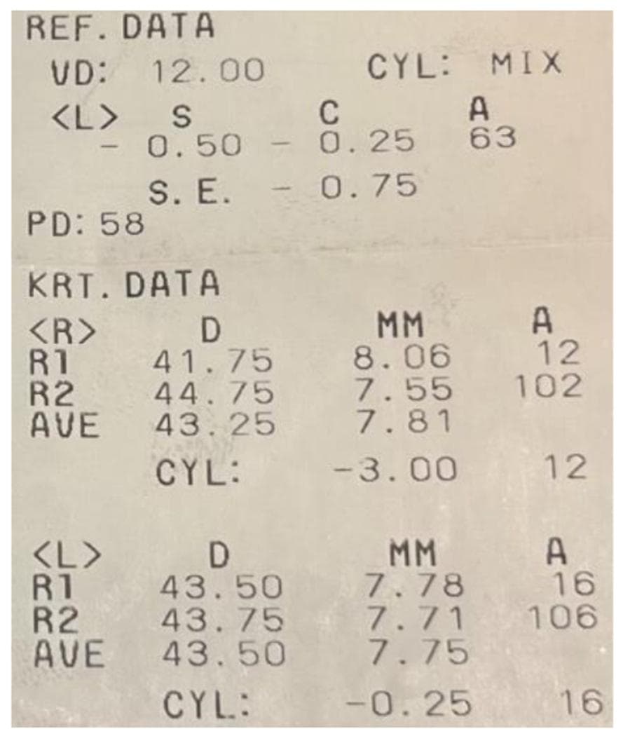 A clinical photograph of a printed thermal receipt containing diagnostic ophthalmological measurements from an automated refractometer/keratometer. The document is divided into two primary sections: REF. DATA (Refractive Data) and KRT. DATA (Keratometry Data).
Under REF. DATA, findings for the left eye <L> are displayed, showing a sphere (S) of -0.50 D, a cylinder (C) of -0.25 D at axis (A) 63, and a spherical equivalent (S.E.) of -0.75. The vertex distance (VD) is 12.00 mm and pupillary distance (PD) is 58 mm.
The KRT. DATA section provides corneal curvature readings for the right <R> and left <L> eyes. For the right eye, R1 and R2 readings indicate a corneal dioptric power (D) of 41.75 and 44.75 respectively, with a resulting high corneal cylinder (CYL) of -3.00 D. For the left eye, R1 and R2 values are 43.50 D and 43.75 D, showing a minimal cylinder of -0.25 D. The data also includes radius of curvature in millimeters (MM) and axis (A) for each meridian. This information is critical for assessing astigmatism and corneal steepness in clinical ocular evaluations.