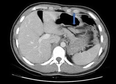 This diagnostic image is an axial contrast-enhanced CT scan of the upper abdomen demonstrating a grade II pancreatic injury. Key anatomical landmarks include the liver in the right upper quadrant, the spleen in the left upper quadrant, the gas-filled stomach centrally, and the vertebral column posteriorly. A blue arrow identifies a focal area of hypoattenuation and disruption within the pancreatic parenchyma, located posterior to the stomach. The injury represents a laceration that does not appear to involve the major pancreatic duct, consistent with the classification of a grade II injury according to the American Association for the Surgery of Trauma (AAST) scale. There is no evidence of large-volume hemoperitoneum or extensive peripancreatic fluid collection in this single slice. The scan is clinically significant for evaluating blunt abdominal trauma and determining the feasibility of non-operative management versus surgical intervention, such as laparoscopic debridement.