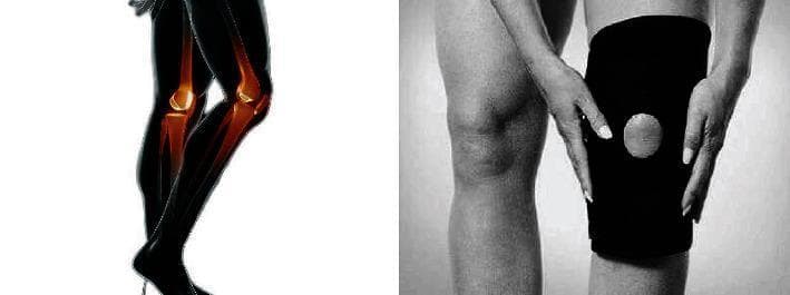 A dual-panel educational graphic illustrating knee anatomy and management of musculoskeletal injuries. The left panel features a stylized anatomical diagram of the lower extremities in profile. The skeletal structure is highlighted in orange against a black silhouette, clearly depicting the femur, tibia, fibula, patella, and the tibiofemoral joint space. The right panel is a clinical photograph in grayscale showing a patient applying or adjusting a neoprene compression knee brace. The brace features an open-patella design (a circular cutout) to stabilize the kneecap and alleviate pressure during physical activity or recovery from sprains, lacerations, or strains. The image demonstrates the relationship between internal joint anatomy and external orthopedic support. This content is relevant to sports medicine, orthopedics, and physical therapy education, focusing on injury prevention and the management of joint instability.