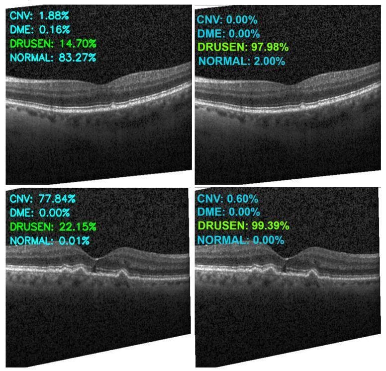 This diagnostic image displays four cross-sectional B-scans of the human retina obtained via Optical Coherence Tomography (OCT). The images are arranged in a 2x2 grid to demonstrate the classification performance of an artificial intelligence model on various macular pathologies. The OCT scans primarily highlight the foveal region and outer retinal layers. Key visible pathology includes subretinal hyperreflective material and undulations of the Retinal Pigment Epithelium (RPE) basement membrane, characteristic of 'Drusen,' which are focal deposits found in age-related macular degeneration. The images in the bottom row specifically show more prominent, dome-shaped elevations of the RPE. Each scan is overlaid with a diagnostic confidence score for four classes: Choroidal Neovascularization (CNV), Diabetic Macular Edema (DME), Drusen, and Normal. The left column represents model predictions without data augmentation, while the right column shows predictions using an augmented training set, illustrating improved diagnostic accuracy for the Drusen class (97.98% and 99.39% respectively) in the presence of subtle pathological features.
