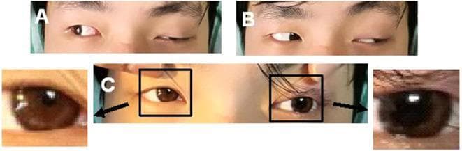 This composite clinical photograph illustrates the hallmark signs of a left oculomotor nerve (third cranial nerve) palsy in a 24-year-old male. Panel A demonstrates significant left-sided ptosis (drooping upper eyelid) and impaired adduction of the left eye when the patient attempts a rightward gaze, resulting in a divergent ocular alignment. Panel B shows preserved abduction of the left eye, indicating intact sixth cranial nerve function. Panel C provides a close-up comparison of the pupils, revealing anisocoria with a dilated, non-reactive left pupil (mydriasis) compared to the right. The combination of ptosis, 'down and out' resting position or inability to adduct, and pupillary involvement is characteristic of complete third nerve paralysis, often associated with compression or intrinsic lesions of the oculomotor nerve. This visual record is educational for identifying neuro-ophthalmic manifestations of cranial nerve pathology, specifically differentiating between pupil-sparing and pupil-involved palsies.