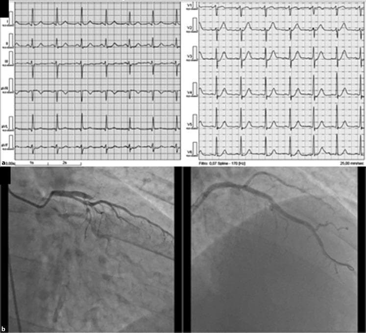 This composite educational image illustrates the correlation between electrocardiographic (ECG) findings and coronary angiography in a patient with acute coronary syndrome. Top: A 12-lead ECG demonstrating the 'modified de Winter' pattern, characterized by 1mm upsloping ST-segment depression at the J point most prominently in leads V3 through V6. This specific pattern is a rare electrocardiographic equivalent of ST-elevation myocardial infarction (STEMI) signaling proximal left anterior descending (LAD) artery occlusion. Bottom: Two coronary angiographic frames (a, left; b, right). The left angiogram shows a 'kissing ostium' variant and a total occlusion of the proximal LAD artery. The right angiogram demonstrates the post-intervention state following primary percutaneous transluminal coronary angioplasty (PTCA), showing successful re-cannulation and stenting of the LAD with restored distal flow. The image provides significant clinical teaching value for identifying non-traditional patterns of acute myocardial ischemia and documenting the efficacy of emergency coronary intervention.