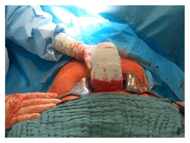 A clinical photograph capturing an intraoperative stage of a cesarean delivery, demonstrating the management of postpartum hemorrhage due to uterine atony. The image shows the exteriorized uterus wrapped tightly in a white elastic compression bandage (uterine bandage technique) to achieve mechanical hemostasis. The bandage shows significant blood staining, particularly at the lower segment. The surgical field is exposed via a transverse abdominal incision held open by two metal retractors. The patient's skin is visible with a reddish-orange hue, likely from antiseptic surgical preparation. The surrounding area is draped with blue sterile cloths and green towels. A surgeon's gloved hand, stained with blood, is visible providing stabilization to the exteriorized organ. This procedure illustrates a conservative surgical intervention used when uterotonic medications fail to induce uterine contraction, aimed at avoiding emergency hysterectomy while promoting uterine tone.