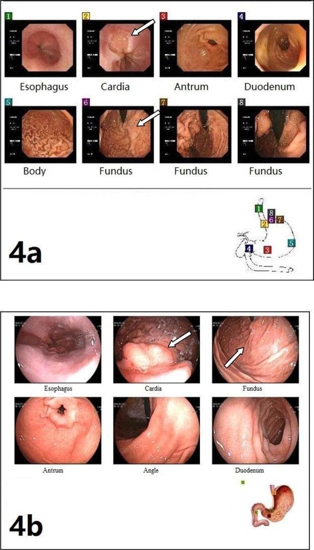 This comparative clinical imaging figure presents two sets of upper gastrointestinal endoscopy panels (4a and 4b) demonstrating the treatment progression of gastroesophageal varices.
Panel 4a (Preoperative): Shows multiple views of the upper GI tract, including the esophagus, cardia, fundus, body, antrum, and duodenum. The cardia and fundus images specifically highlight prominent, tortuous, and elevated gastric varices (marked with arrows) and irregular mucosal texture characteristic of portal hypertension. The gastric body displays typical rugal folds, while the antrum and duodenum provide anatomical reference.
Panel 4b (Postoperative): Displays a follow-up endoscopy of the same regions after shunt surgery and foam sclerotherapy. There is a marked reduction in the size and prominence of gastric varices in the cardia and fundus (indicated by arrows), showing a smoother mucosal surface. However, residual esophageal varices remain visible. Small anatomical maps accompany each panel to indicate the endoscopic orientation within the stomach. This figure serves as an educational tool for assessing the efficacy of surgical and sclerotherapeutic interventions in managing portal hypertension-related variceal bleeding.