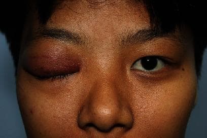 Clinical photograph of a patient's face showing a comparison between the right and left ocular regions. The right upper eyelid exhibits significant pathology characterized by marked edema (swelling), diffuse erythema, and complete mechanical ptosis, where the eyelid droops to entirely obscure the globe. The swelling appears localized to the right upper eyelid and superolateral orbital area, suggestive of a firm, underlying infiltrative mass. In contrast, the left eye appears normal with clear anatomical landmarks, healthy skin texture, and proper eyelid positioning. The image illustrates a unilateral orbital or eyelid inflammatory process, often associated with infectious or granulomatous conditions such as orbital cellulitis or zygomycosis (e.g., Saksenaea vasiformis). This visual is intended for ophthalmology and dermatology education to demonstrate clinical manifestations of severe eyelid lesions and differential diagnosis of mechanical ptosis.