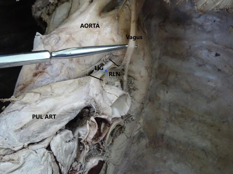 A clinical photograph of a cadaveric dissection focused on the superior mediastinum, specifically demonstrating the relationship between major cardiovascular and neurovascular structures. The aortic arch is positioned superiorly, with the pulmonary artery (PUL ART) located inferior to it. Connecting these two vessels is the ligamentum arteriosum (LIG), a fibrous remnant of the ductus arteriosus, shown as a short, taut band. The left vagus nerve descends vertically, crossing the lateral aspect of the aortic arch. The left recurrent laryngeal nerve (RLN) is clearly visible branching from the vagus nerve and looping medially and superiorly beneath the aortic arch, just posterior to the ligamentum arteriosum. A metal surgical probe is used to retract the vagus nerve for better visualization of the RLN's origin. This anatomical illustration highlights the clinical importance of the RLN's course, particularly in thoracic surgery or cases of aortic pathology where the nerve may be compressed or injured, leading to vocal cord paralysis.