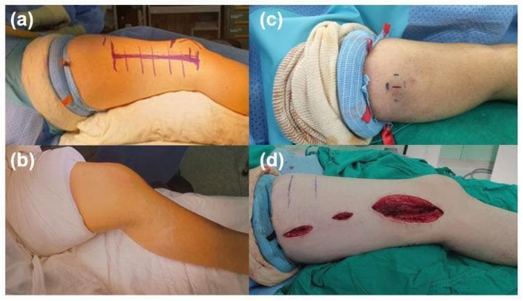 A four-panel clinical photograph comparison demonstrating surgical site exposure provided by different tourniquet types in pediatric orthopedic surgery. Panel (a) illustrates a sterile silicone ring tourniquet applied to the upper thigh, showing its narrow profile (approximately 2-3 cm) and excellent proximal limb exposure for a planned femur incision. Panel (b) shows a conventional pneumatic tourniquet on the proximal thigh, which is significantly wider (8-16 cm) and limits surgical access to the upper thigh. Panel (c) demonstrates a sterile silicone ring tourniquet applied to the upper arm for the excision of a distal humerus region lesion (pilomatricoma), showing minimal interference with the operative field. Panel (d) shows the intraoperative application of the silicone ring tourniquet on the proximal thigh during an open reduction and internal fixation of a femur shaft fracture, highlighting its ability to maintain a bloodless field and provide maximal exposure for extensive longitudinal incisions. The images emphasize the educational objective of choosing appropriate hemostatic devices to optimize the surgical field in pediatric patients with short limb lengths.