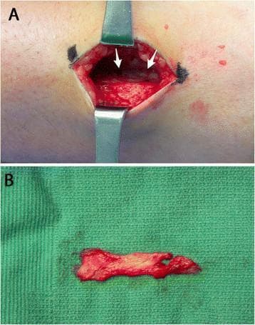 This composite clinical photograph depicts a key step in a posterior tibialis tendon (PTT) transfer surgical procedure for foot drop. Image A shows an intraoperative view of the lower leg where a surgical incision is held open by metal retractors. The extensor digitorum longus muscle is elevated medially to expose the crural interosseous membrane (indicated by white arrows), which appears as a white, fibrous, translucent tissue plane. Image B displays a 4-cm excised segment of the interosseous membrane resting on a green sterile surgical drape. The specimen is irregularly rectangular, exhibiting a dense fibrous texture with focal areas of blood staining and small amounts of adherent muscle tissue. This excision is performed to create a surgical window, allowing the PTT to pass from the posterior to the anterior compartment without entrapment or mechanical scarring. This visual material is intended for orthopedic and plastic surgery education, focusing on surgical anatomy and tendon transfer techniques.