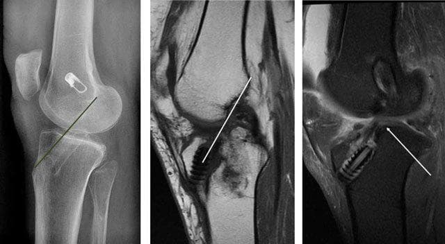 A comparative diagnostic series of the knee joint post-anterior cruciate ligament (ACL) reconstruction. (a) Lateral radiograph demonstrating optimal tibial tunnel positioning. A reference line (Blumensaat’s line) is superimposed, showing the tunnel exit situated entirely posterior to the line of the intercondylar roof, preventing impingement. (b) Sagittal T1-weighted MRI and (c) Sagittal T2-weighted MRI of a different patient demonstrating suboptimal, anterior tibial tunnel placement. The MRI scans reveal the ACL graft is positioned anterior to the projected Blumensaat's line, causing mechanical impingement. Visually, this results in a characteristic 's-shaped' deformity or buckling of the graft, as indicated by the white arrow in (c). High signal intensity within the graft on T2-weighted imaging and thinning of the fibers at the point of impingement are evident, suggesting graft irritation or partial tearing. The images serve as an educational comparison between successful surgical tunnel placement and the radiological signs of impingement syndrome in ligament reconstruction.