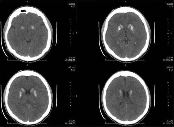 This diagnostic image is a non-contrast computed tomography (CT) scan of the brain, presented in four axial sections. The imaging reveals prominent, bilateral, and highly symmetrical hyperdense areas within the basal ganglia, specifically involving the putamen and the caudate nuclei. These hyperdensities are consistent with intracranial calcifications. There is no evidence of mass effect, midline shift, or acute intracranial hemorrhage visible in these slices. The distribution of these calcifications is a key clinical finding often associated with metabolic disorders, such as primary hypoparathyroidism or Fahr's syndrome. This content is suitable for neurological and radiological education regarding the identification of ectopic intracranial calcification and its anatomical localization within the deep gray matter structures.