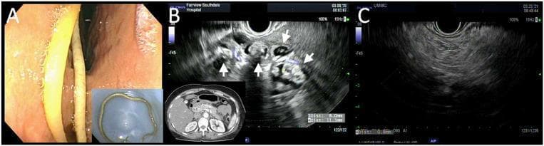 A multi-panel clinical graphic demonstrating gastric ascariasis and associated complications. Panel A shows a white-light endoscopic view of the gastric antrum containing a long, slender, pale yellowish cylindrical roundworm, identified as Ascaris lumbricoides. An inset displays the extracted intact worm. Panel B features an endoscopic ultrasound (EUS) image alongside a transverse CT slice of the abdomen. The EUS reveals a complex, heterogeneous region adjacent to the pancreatic tail containing multiple hypoechoic, roughly circular cystic structures (indicated by white arrows), representing egg collections or localized inflammation. The associated CT scan shows diffuse edematous enlargement of the pancreas consistent with acute interstitial pancreatitis. Panel C shows a follow-up EUS image after anthelmintic treatment with albendazole, demonstrating complete resolution of the cystic structures and return to more homogeneous pancreatic parenchyma. This sequence illustrates the diagnostic utility of EUS in identifying parasitic etiologies for acute pancreatitis and monitoring treatment response.