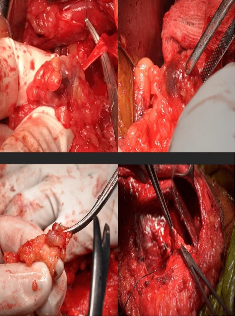 This composite of four clinical photographs illustrates an intraoperative sentinel lymph node biopsy (SLNB) procedure, likely during breast cancer surgery. The images show the identification and dissection of sentinel lymph nodes within the axillary or breast tissue. A key diagnostic feature is the dark blue staining of specific nodes, resulting from the peritumoral or subareolar injection of methylene blue dye, which allows for visual tracking of lymphatic drainage. The surgical field displays a mix of erythematous muscle tissue and yellowish adipose tissue, with surgical instruments such as forceps and retractors used to isolate the nodes. One frame shows a resected node held in forceps for intraoperative pathological assessment. This visual demonstrates the surgical technique used to identify the first draining lymph nodes in oncological staging to determine the necessity of a full axillary lymph node dissection (ALND).