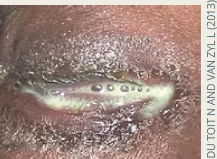 This clinical photograph displays a close-up view of an eye presenting with severe ophthalmia neonatorum, specifically hyperacute purulent conjunctivitis. The eyelids exhibit significant erythema and marked periorbital edema, causing them to be nearly swollen shut. A copious, thick, yellowish-white purulent discharge (pus) is seen oozing from the palpebral fissure and coating the eyelid margins and eyelashes. Small air bubbles or droplets are visible within the viscous exudate. The clinical appearance is highly characteristic of Neisseria gonorrhoeae infection, demonstrating the hallmark symptom of rapid-onset, profuse discharge that poses a high risk for corneal ulceration and perforation if not treated emergently. The image serves as an educational tool for identifying neonatal infectious emergencies and differentiating hyperacute bacterial conjunctivitis from milder forms of neonatal eye infections.