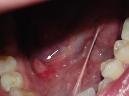 A close-up intraoral clinical photograph showing a minor recurrent aphthous ulcer on the right floor of the mouth. The lesion, indicated by a white arrow, is a small, well-circumscribed, ovoid ulcer characterized by a central pseudomembranous base that is yellowish-white in color. This central area is surrounded by a prominent, erythematous (reddened) halo, indicating localized inflammation. The surrounding oral mucosa of the floor of the mouth appears moist and pink with visible sublingual vasculature. Other visible structures include the lingual frenulum stretching vertically and several healthy molar and premolar teeth on the lateral borders of the image. This photograph serves as an educational example of aphthous stomatitis (canker sores), demonstrating the classic morphology and location within the non-keratinized oral mucosa for students and clinical professionals.