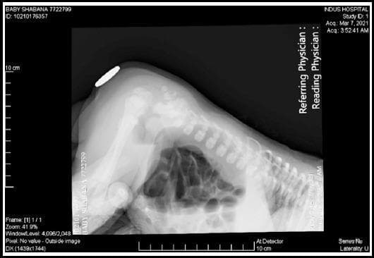 This diagnostic image is a lateral invertogram (Wangensteen-Rice view) of a neonate, a specialized pediatric radiograph used to evaluate anorectal malformations. The infant is positioned in a prone, head-down (inverted) posture to allow bowel gas to rise toward the perineum. A radiopaque marker is placed on the skin surface at the expected site of the anus. The radiograph reveals significant bowel gas distension with multiple dilated intestinal loops, consistent with a distal bowel obstruction. The distance between the most distal rectal gas bubble and the external perineal marker is used to classify the malformation as a 'high' or 'low' type defect. Anatomical landmarks visible include the infant's lumbar and sacral spine, pelvis, and femur, showing age-appropriate incomplete ossification. This imaging modality is critical in pediatric surgery for planning the initial management and surgical approach for congenital imperforate anus.