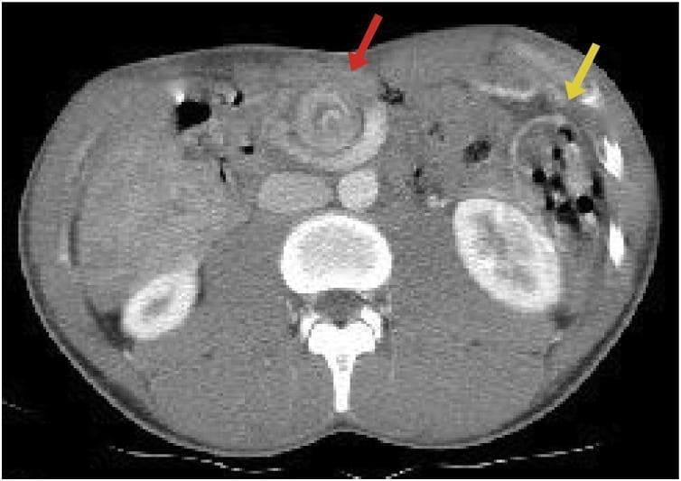 This axial contrast-enhanced abdominal CT scan illustrates pathognomonic findings of intestinal malrotation and midgut volvulus. A prominent 'whirlpool sign' (indicated by a red arrow) is visible in the central abdomen, characterized by the spiral twisting of the superior mesenteric vein and mesentery around the superior mesenteric artery. Additionally, the image demonstrates an aberrant bowel distribution (indicated by a yellow arrow), where small bowel loops are predominantly located in the right hemiabdomen and the colon is displaced to the left, confirming a failure of normal embryological rotation. These radiological findings are critical for the diagnosis of acute midgut volvulus, highlighting the risk of mesenteric vascular compromise and bowel ischemia. The image serves as a high-level educational example for radiology and pediatric surgery trainees regarding congenital gastrointestinal anomalies and acute abdominal emergencies.