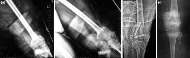 A series of four diagnostic x-ray radiographs documenting the management of a giant cell tumor (GCT) of the distal femur. (a, b) Pre-operative anteroposterior and lateral views showing a large, osteolytic lesion in the distal femoral metaphysis with associated cortical thinning and a pathological fracture, resulting in significant joint misalignment. (c) Immediate post-operative radiograph demonstrating surgical reconstruction following intralesional curettage. The reconstruction utilizes internal fixation with multiple orthopedic screws and cerclage wires alongside bone grafting (fibula struts) to stabilize the fracture site and restore anatomical alignment. (d) Two-year post-operative radiograph showing advanced bone healing and remodeling. There is significant graft consolidation and restoration of the distal femoral shape and bone density. The joint space is maintained, and hardware remains in situ with no evidence of tumor recurrence or subchondral collapse. This sequence illustrates a successful orthopedic oncology intervention for aggressive benign bone tumors complicated by fracture.