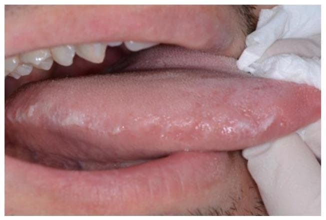 This clinical photograph displays a close-up intraoral view of the lateral margin of the tongue. The primary clinical finding is oral hairy leukoplakia, characterized by multiple adherent, whitish-gray plaques. These lesions exhibit a distinct corrugated, vertically-oriented, or 'hairy' surface texture and are localized along the lateral tongue border. The lesions are non-scrapable and irregular in shape. Surrounding oral structures, including the visible maxillary teeth and lower lip, appear within normal limits without evidence of generalized inflammation. In an educational context, this manifestation is a classic marker of Epstein-Barr virus (EBV) replication within the oral epithelium, frequently occurring in immunocompromised individuals, such as those with HIV infection. The image serves as a diagnostic reference for identifying opportunistic oral viral infections and highlights the importance of oral examination in systemic disease monitoring.