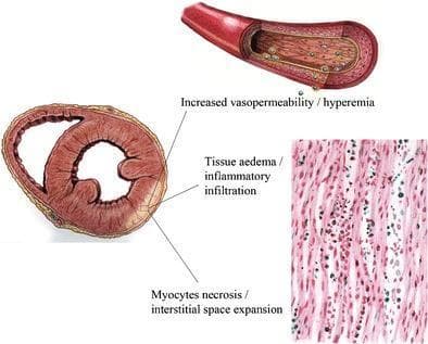 An educational anatomical and pathophysiological diagram illustrating the tissue hallmarks of acute myocarditis. The illustration includes three main components: a cross-sectional schematic of the heart ventricles, a detailed view of a blood vessel, and a simulated histopathology section. The ventricular cross-section highlights a localized inferior-lateral lesion in the left ventricle, showing subepicardial spread consistent with typical myocarditis patterns. Labels identify key pathological processes: 'Increased vasopermeability / hyperemia,' depicted by a dilated blood vessel with leaking fluid particles; 'Tissue oedema / inflammatory infiltration,' indicated by lighter coloration and texture changes in the myocardial wall; and 'Myocyte necrosis / interstitial space expansion,' illustrated in the simulated histology panel. This microscopic view shows eosinophilic cardiomyocytes with interspersed blue-stained inflammatory cells and expanded spaces between fibers. The diagram serves to correlate macroscopic Cardiac Magnetic Resonance (CMR) targets with cellular-level inflammatory mechanisms including viral-induced immunoreactive responses and vasoactive phenomena.