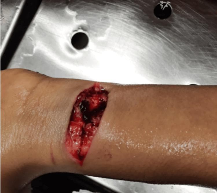 Clinical photograph of the ventral aspect of the left wrist during a medicolegal autopsy. The image displays two distinct incised wounds. A primary deep, gaping incision (approximately 7 cm x 2 cm) is oriented transversely across the wrist. The wound edges are clean-cut, revealing exposure of the subcutaneous adipose tissue, underlying tendons, and superficial blood vessels, with clotted blood visible within the wound cavity. Distal to this larger wound is a secondary, superficial incision (approximately 2 cm x 0.1 cm) oriented parallel to the primary injury, characteristic of a 'hesitation mark.' These findings are significant in forensic pathology for evaluating self-inflicted injuries and suicidal behavior. The photograph is taken against a stainless steel background typical of a morgue or clinical setting, focusing on the traumatic skin lesions and underlying structural damage.