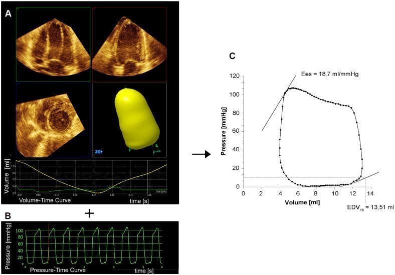 Educational composite image illustrating the generation of ventricular pressure-volume loops (PVL) from diagnostic data. Panel A displays three-dimensional real-time echocardiography (3DE) data, featuring multi-plane apical and short-axis sectional views of the left ventricle alongside a 3D volumetric reconstruction. Below this is a volume-time curve (ml vs. s) tracking ventricular filling and emptying. Panel B presents a pressure-time curve (mmHg vs. s) derived from an invasive mini-pressure wire. Panel C shows the integrated result: a pressure-volume loop mapping the cardiac cycle. Key hemodynamic indices are identified on the PVL, including end-systolic elastance (Ees = 18.7 ml/mmHg), represented by the slope of the end-systolic pressure-volume relationship, and the indexed end-diastolic volume at 10 mmHg (EDV10 = 13.51 ml). This figure demonstrates the methodology for assessing cardiac contractility and compliance by synchronizing non-invasive volumetric imaging with invasive manometry.