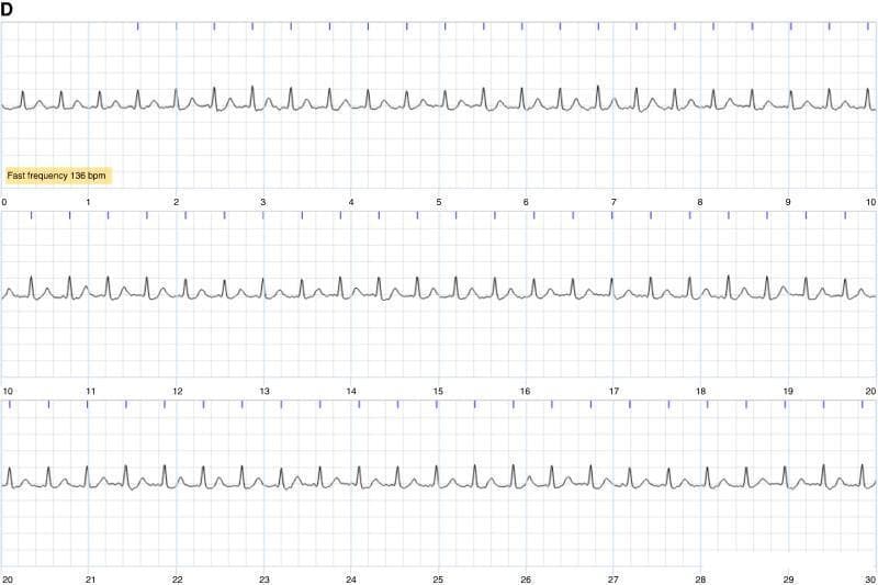 A diagnostic single-lead electrocardiogram (ECG) tracing spanning 30 seconds, organized into three 10-second strips. The tracing demonstrates a tachycardic rhythm with a labeled heart rate of 136 bpm. The QRS complexes are narrow and appear morphologically consistent throughout the recording. The R-R intervals exhibit a high degree of regularity, though subtle variations may exist. P waves are not clearly identifiable preceding each QRS complex, replaced by a baseline that suggests either atrial fibrillation (AF) or atrial tachycardia, as indicated by clinical context. The ST segments remain generally isoelectric, and the T waves follow each QRS complex with consistent polarity. This image serves as an educational tool for cardiology, illustrating the diagnostic challenge in differentiating between regular supraventricular tachycardias and atrial fibrillation when P waves are indistinct. It is suitable for medical students and clinicians focusing on cardiac electrophysiology and rhythm interpretation.