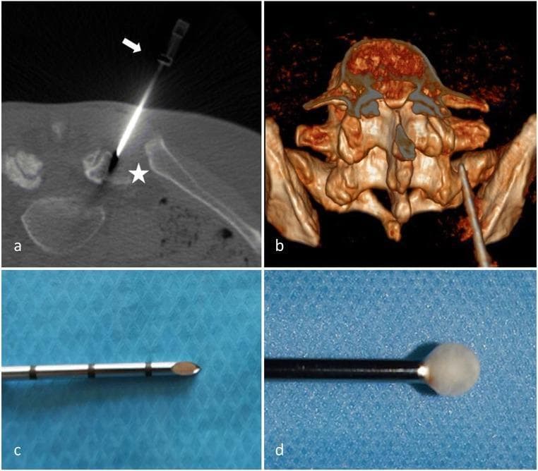 This four-panel image illustrates facet joint cryoneurolysis at the right L5-S1 level using CT guidance. Panel (a) is an axial CT image showing a cryoprobe (white arrow) precisely positioned against the ala of the sacrum (white star), a landmark for targeting the medial branch of the dorsal rami. Panel (b) provides a 3D CT reconstruction of the lumbosacral junction, depicting the posterior approach of the cryoprobe relative to the spinal anatomy. Panels (c) and (d) are close-up clinical photographs of the cryoprobe tip. Panel (c) shows the 12G metallic cryoprobe with visible depth markings and a sharp, conical tip. Panel (d) demonstrates the Joule-Thompson effect, showing a spherical, opaque 'ice-ball' formation at the tip during the freezing cycle. This procedure is used for chronic low back pain management by ablating nociceptive nerve fibers in the facet joint capsule. The visual content serves as an educational guide for interventional radiologists and pain management specialists regarding needle trajectory and the physical mechanism of cryoablation.