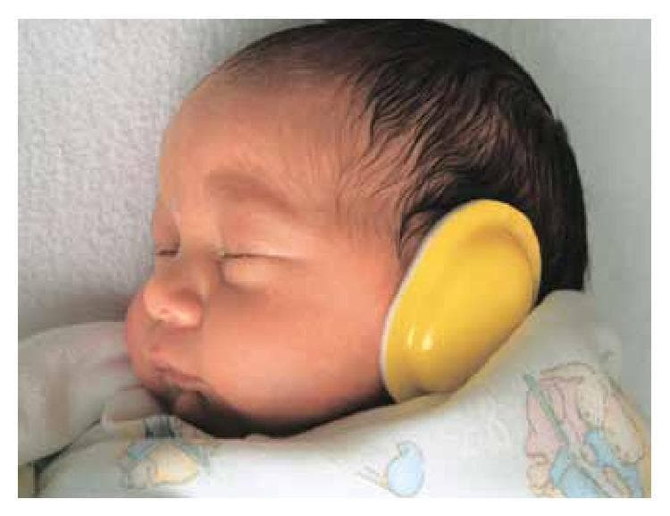 This clinical photograph displays a newborn infant in a resting state within a Neonatal Intensive Care Unit (NICU) setting. The infant is shown in a lateral profile, featuring a fair skin tone and dark, fine terminal hair. A primary visual focus is a yellow, oval-shaped noise-reduction earmuff applied over the external ear. This device is utilized as a non-pharmacological intervention aimed at neuroprotection and developmental care by mitigating high decibel levels in the NICU environment. Such interventions are clinically relevant for reducing stress-induced motor responses, such as tremors and startle reflexes, and for supporting physiological stability and weight gain in neonates. The image demonstrates the practical application of environmental modification protocols designed to protect fragile auditory systems and promote neurodevelopmental maturation in early infancy.