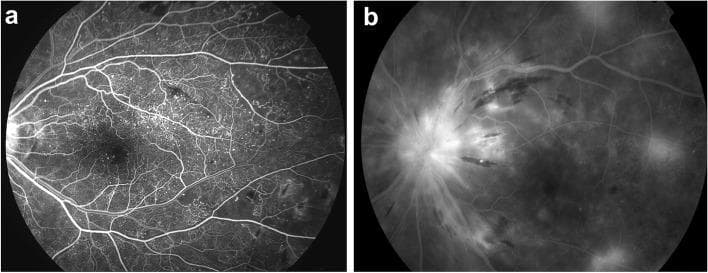 This diagnostic comparison contains two retinal fluorescein angiography (FA) images illustrating vascular complications in diabetic retinopathy. Image (a) depicts diffuse capillary telangiectasis at the posterior pole. It is characterized by widespread, punctate hyperfluorescent spots representing dilated, leaky capillaries and microaneurysms scattered throughout the retinal vascular bed, while larger retinal vessels remain well-defined. Image (b) shows a late-phase angiogram demonstrating significant late disc leakage. This is visualized as intense, blurred hyperfluorescence centered on the optic nerve head, indicating a breakdown of the blood-retinal barrier at the disc. The leakage is accompanied by more generalized, hazy hyperfluorescence across the retina, contrasting with the discrete vascular findings in image (a). These images serve as educational examples of microvascular deterioration and the resulting pathological permeability changes in advanced retinal disease, used to identify prognostic indicators for treatment response.